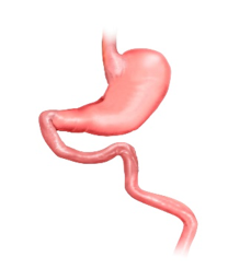 Gastric Bypass operatie stap 1