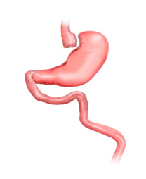Gastric Bypass operatie stap 2